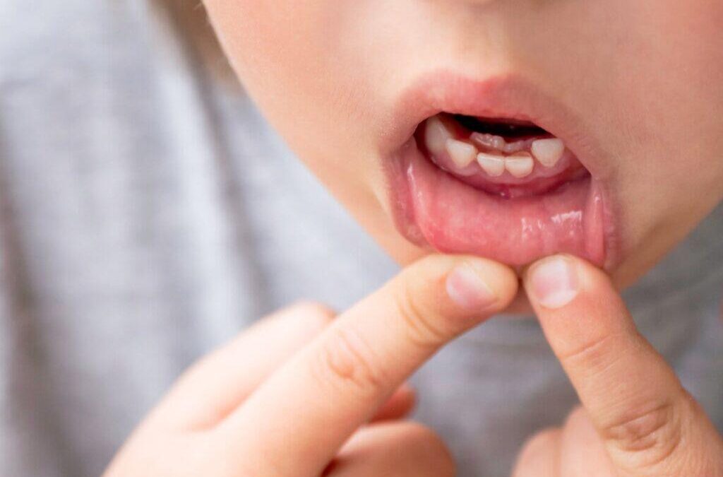 Hiperdòncia: quan tens més dents del compte! 😲🦷